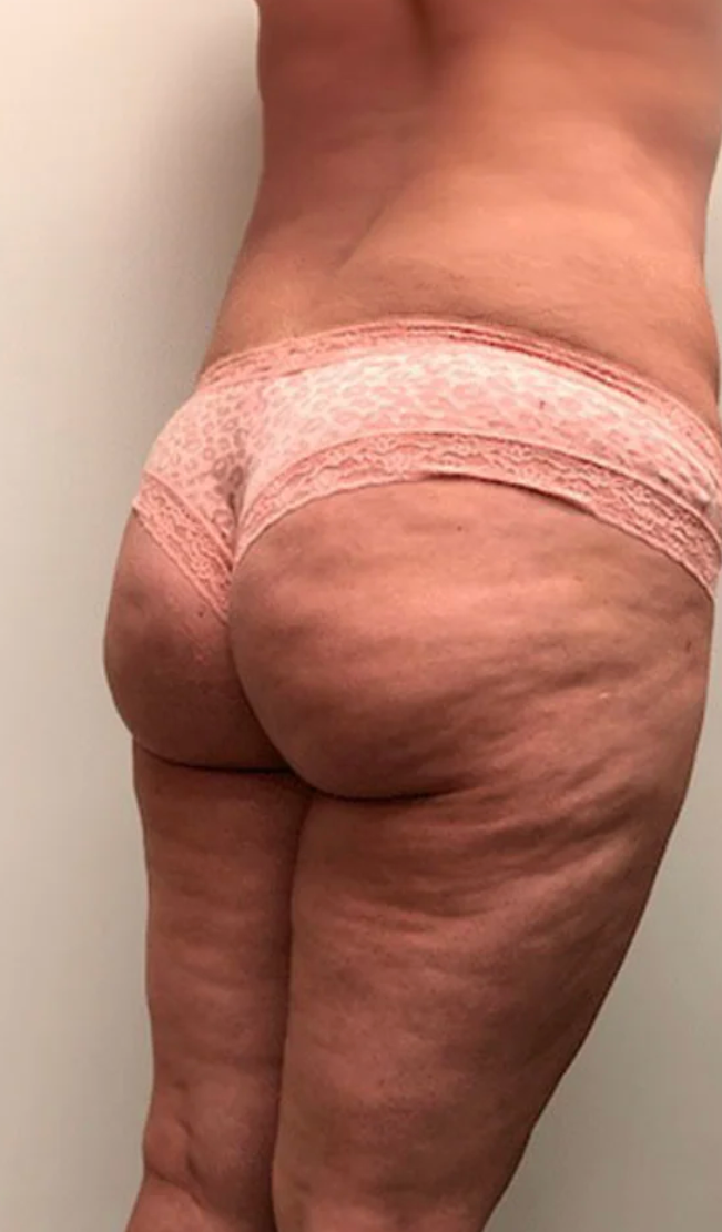 Before using Sculpta