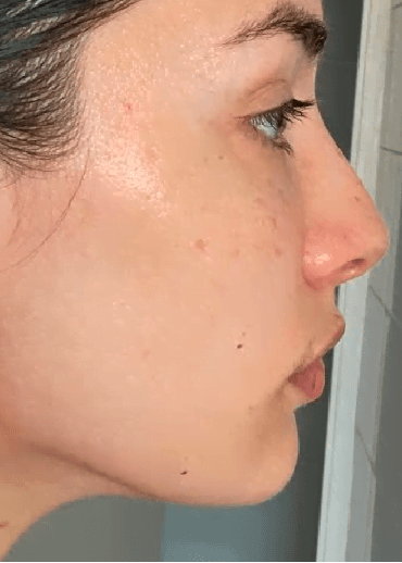 After using Sculpta Facelift Pro