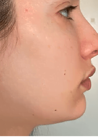 Before using Sculpta Facelift Pro